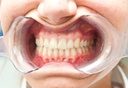 Separador Labial Abreboca Unilateral Machtig