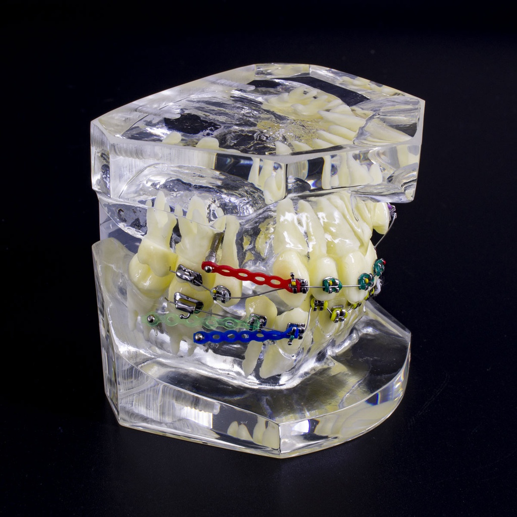 Modelo estudio maxilares Ortodoncia con tratamiento A M3005-3 Machtig