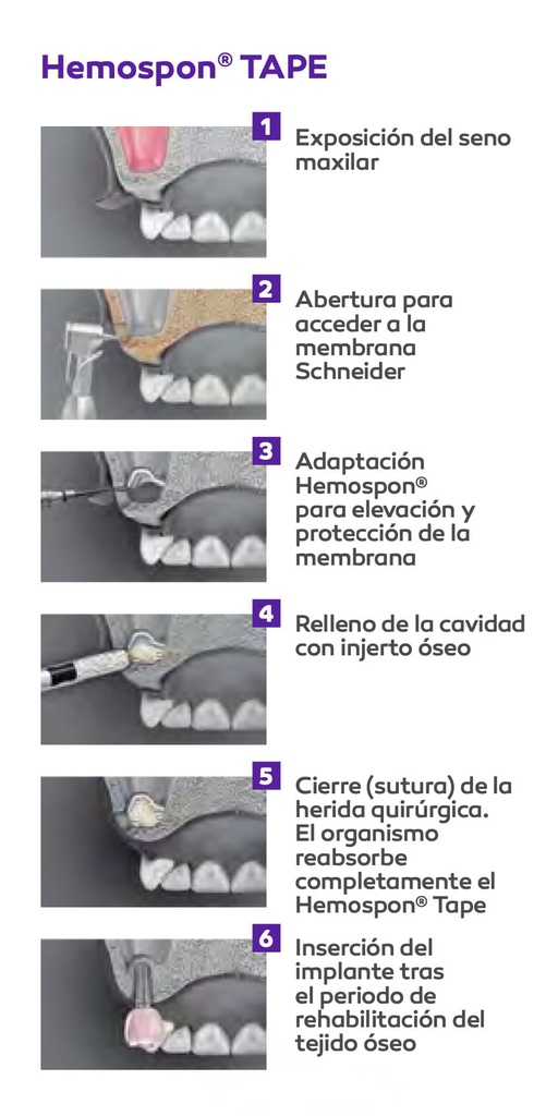 Esponja Hemostática de colágeno Hemospon Tape Hemospon