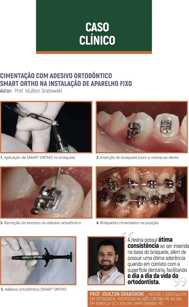 Resina para brackets Smart Ortho Smart Dent