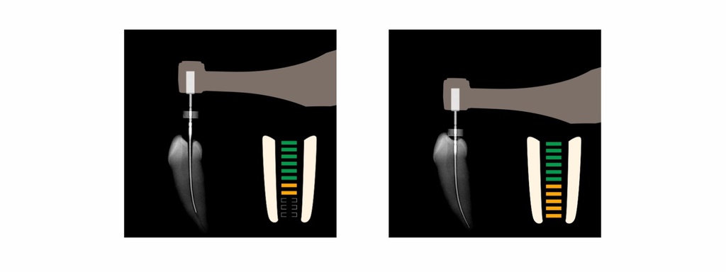 Motor Endodoncia y Loc.Ápice Endo Radar Woodpecker