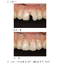 Resina Composite Palfique LX5 Tokuyama