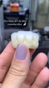 Disco de Zirconio Pro 3D Multi Ultra Translucidez TT xxmm Miiyen Baot