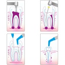 Cánulas para Aspiración para Endodoncia Cotisen