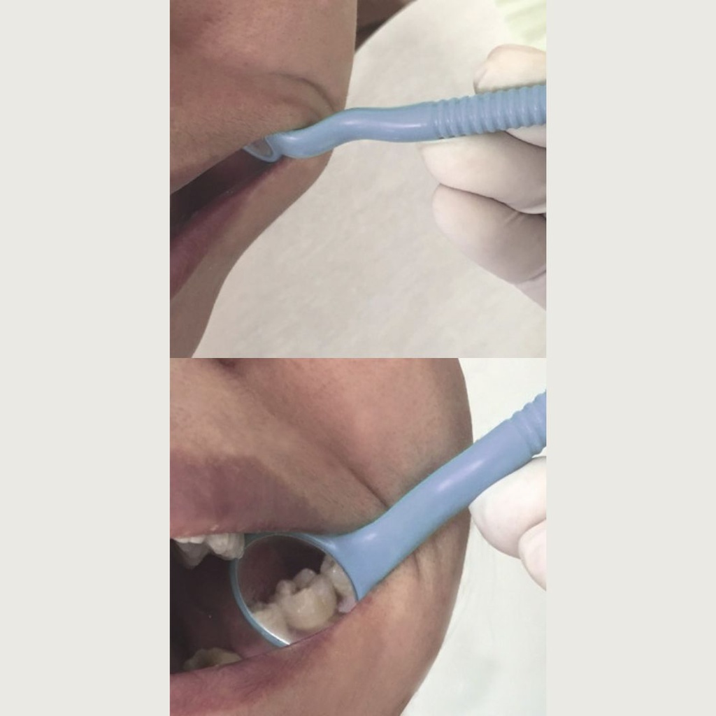 Espejo Doble intraoral con mango Autoclavable Ehros