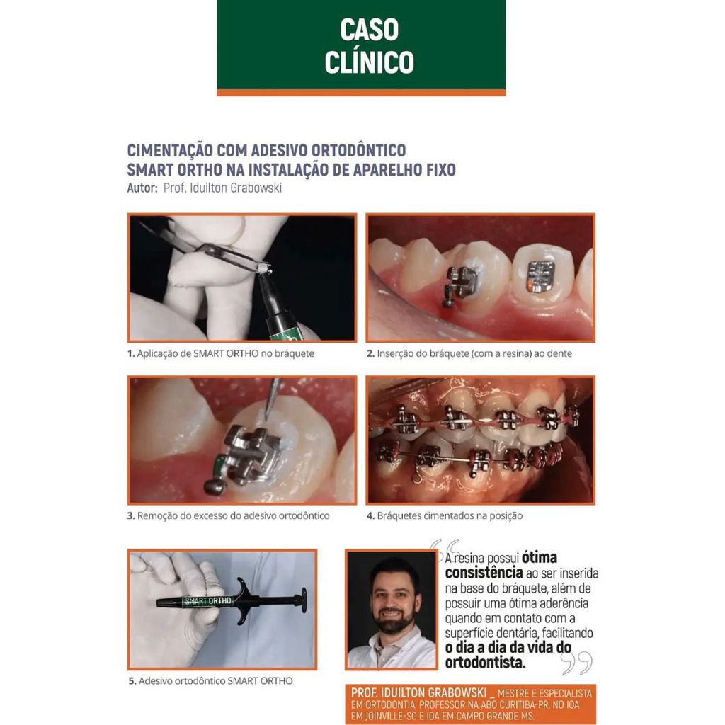 Adhesivo para brackets fotocurado Smart Ortho MDP Smart Dent