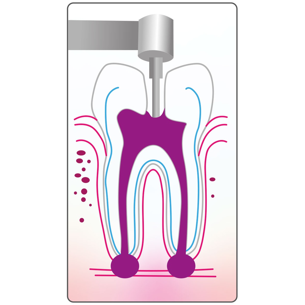 Cánulas Aspiración para Endodoncia Cotisen