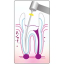 Cánulas Aspiración para Endodoncia Cotisen