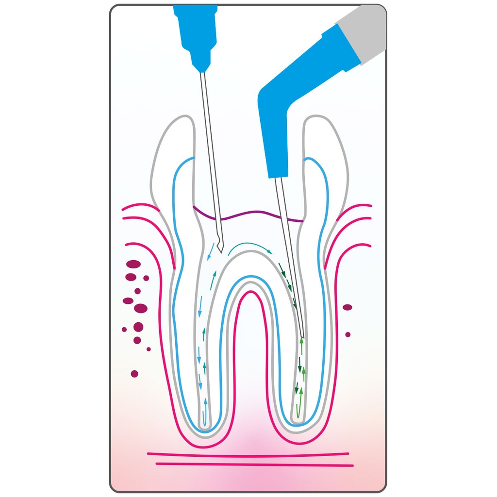 Cánulas Aspiración para Endodoncia Cotisen