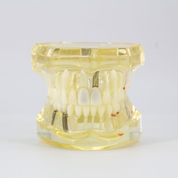 [DIA3010] Modelo estudio con Restauraciones Adulto M2001 Machtig